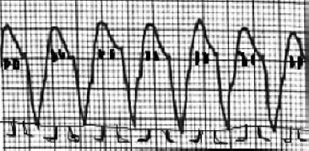 EKG tracing of ventricular tachycardia "ghosts